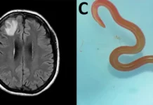 Un gusano vivo en el cerebro de una mujer y otras 4 noticias de salud que causaron impacto en 2023