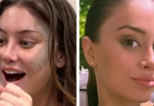 «Me quedé dormida y desperté con una cara nueva»: la chica de 28 años que se hizo un estiramiento facial y por qué cada vez más jóvenes lo hacen