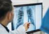 Qué es un adenocarcinoma pulmonar, el tipo de tumor maligno que le extirparon al papa León XIV