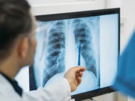 Qué es un adenocarcinoma pulmonar, el tipo de tumor maligno que le extirparon al papa León XIV